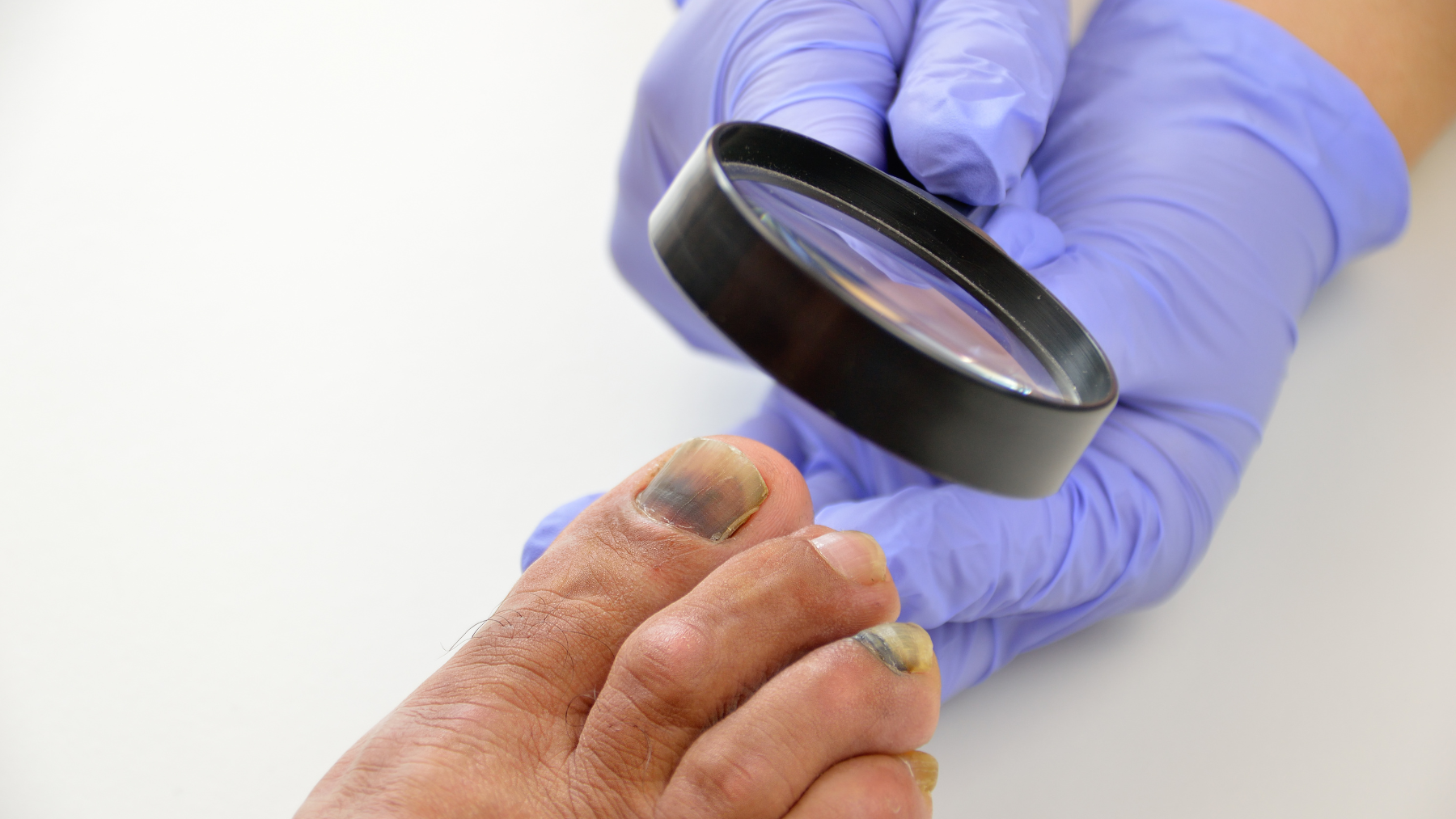 Jak leczyć czerniaka skóry i paznokci?